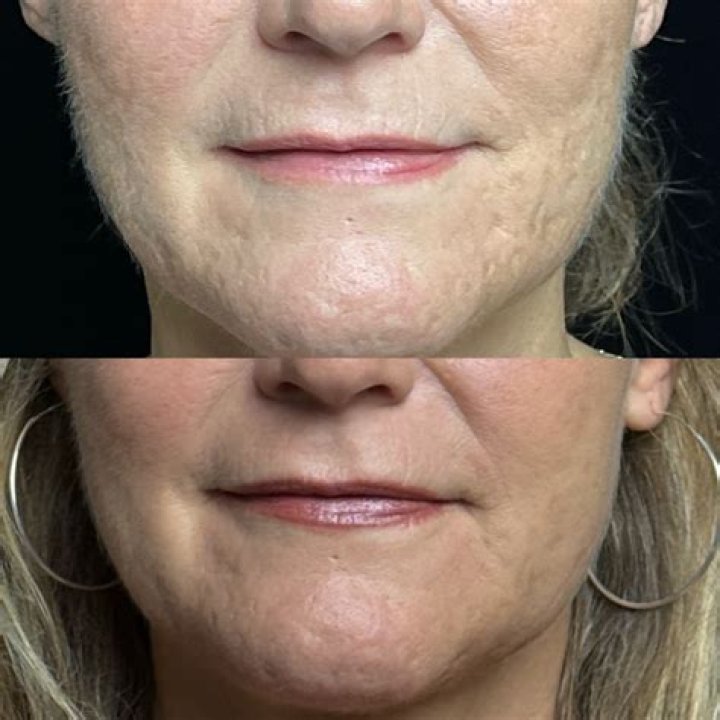 Unveiling Bellafill: Before And After Revelations